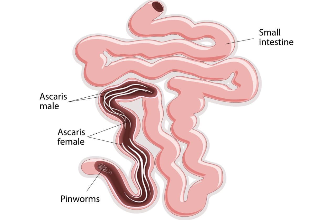 50+ Parasiten im darm bilder , Parasiten im Darm ein weltweites Gesundheitsproblem! Die Erklärung.